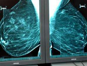 Fewer Iowans dying of breast cancer, new report shows