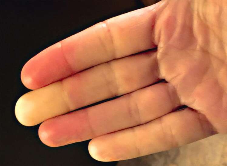 Are you really sensitive to cold? Raynaud’s syndrome could be to blame for numbness, pain