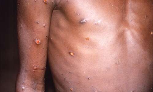 First probable case of monkeypox reported in Iowa
